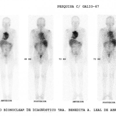 Cintilografia com Gálio 67