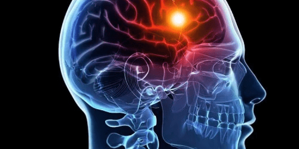 Cintilografia de Perfusão Cerebral SPECT (ECD-Tecnécio 99)