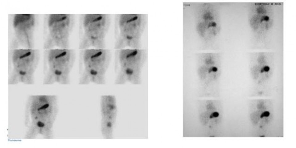 Cintilografia para Pesquisa de Divertículo de Meckel
