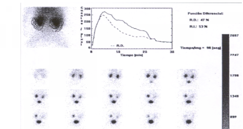 Cintilografia renal com DTPA_Tc99m